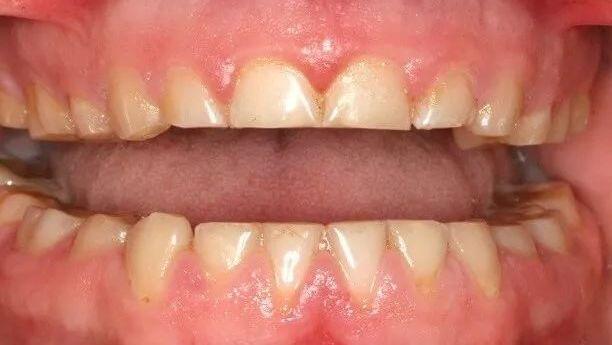 晚上睡觉磨牙是肚子里面有虫吗