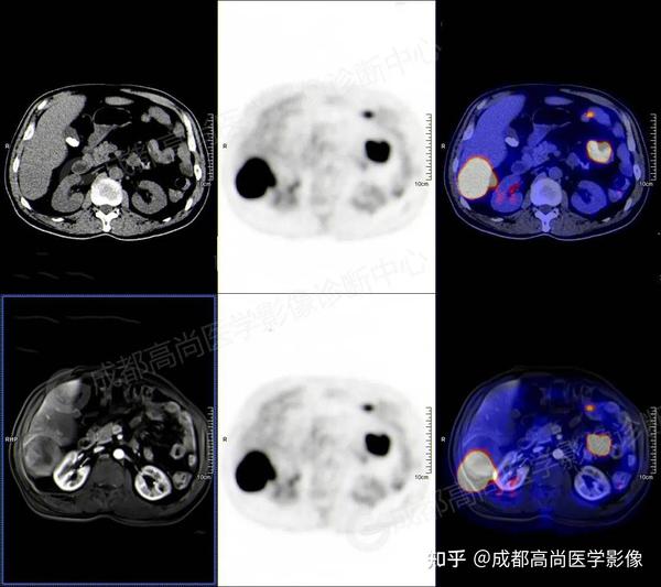 【高尚病例】PET-CT/MRI多模态检查实现“一站式”诊断 - 知乎