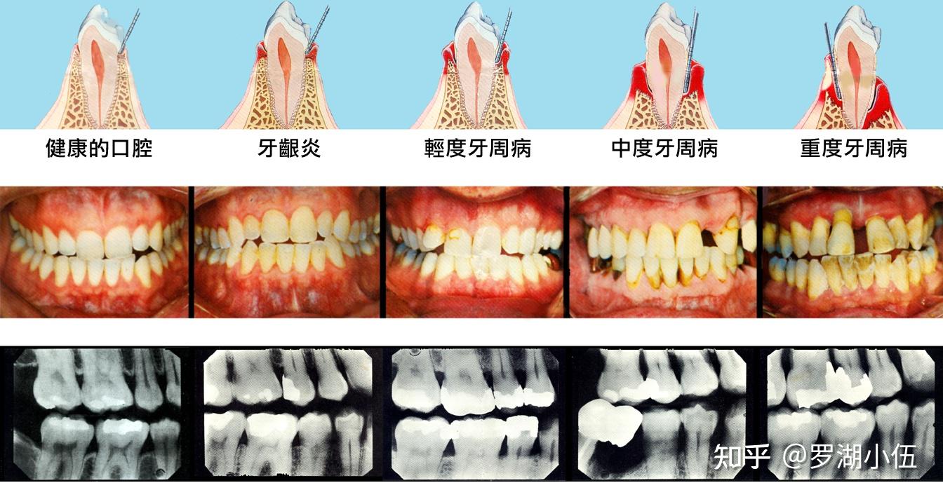 1,牙根发炎(多见于严重蛀牙,补牙和根管治疗后的患者)当蛀牙蛀到牙髓