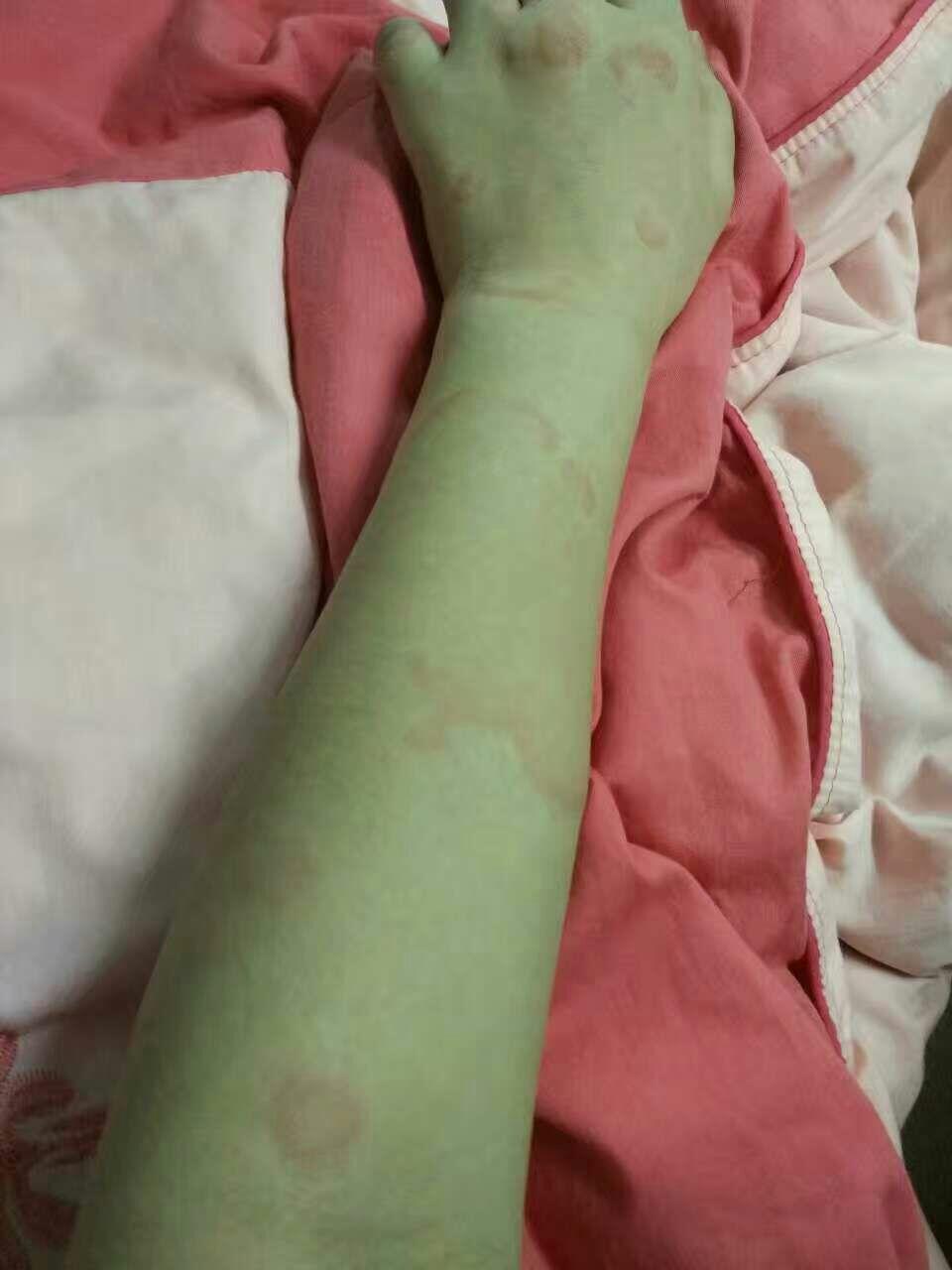 长期性荨麻疹,平时靠盐酸西替利嗪才能缓解,否