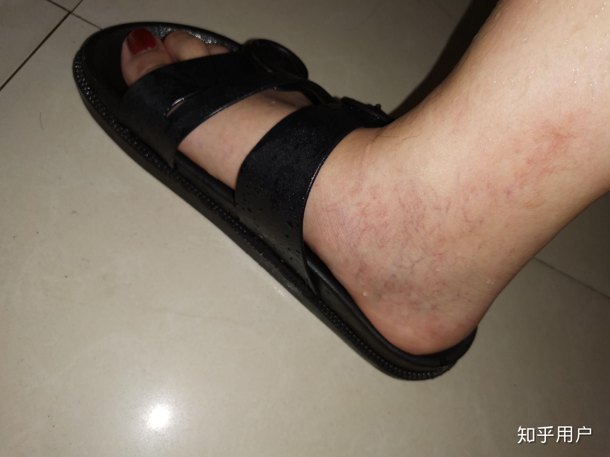 腿上静脉曲张很多红血丝怎么办