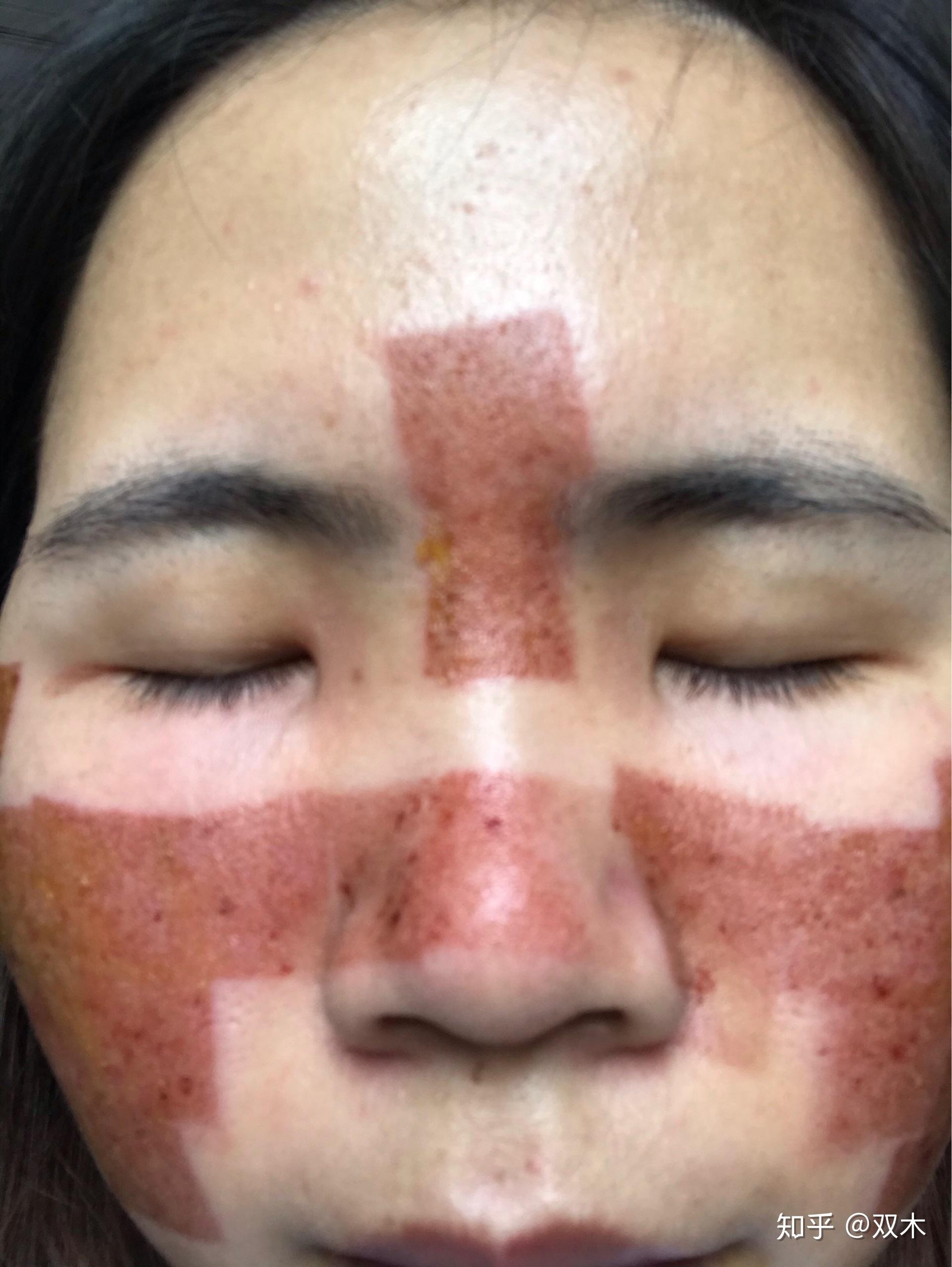 点阵激光第三天