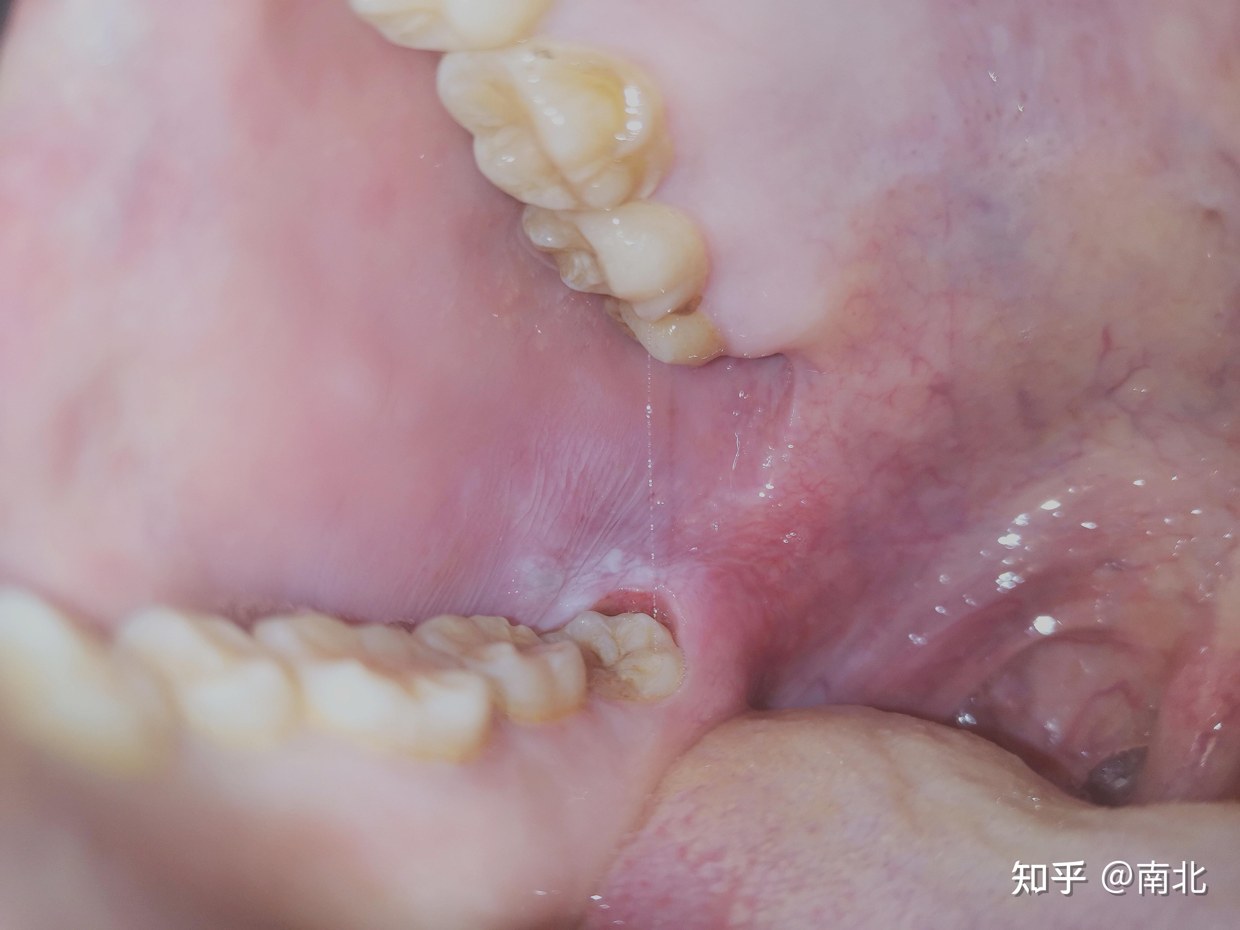 智齿，冠周炎，半夜疼醒，治疗经历分享 - 知乎