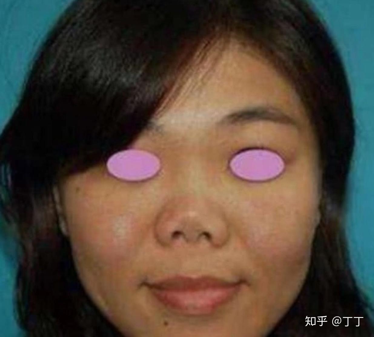 还有就是朝天鼻,没有鼻梁,鼻孔外翻我们亚洲最常见的塌鼻子,没有什么