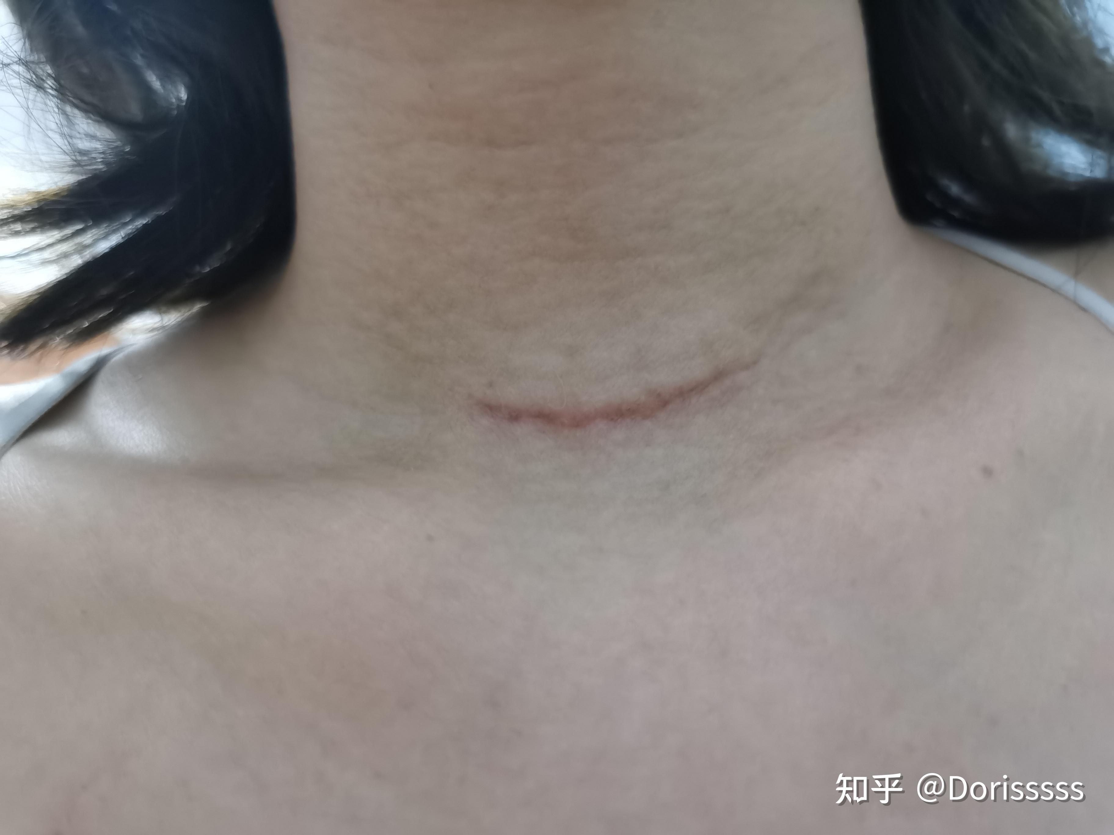 甲状腺癌全切小记录ep7术后三个月碘131后一个月疤痕情况一览么哈哈哈