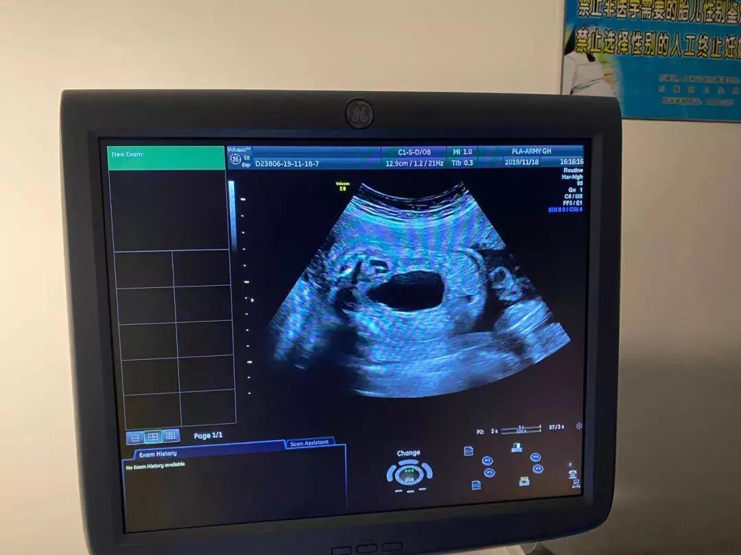 孕妇妊娠28周,因发现胎儿双肾输尿管积水膀胱极度充盈5天,伴不规则