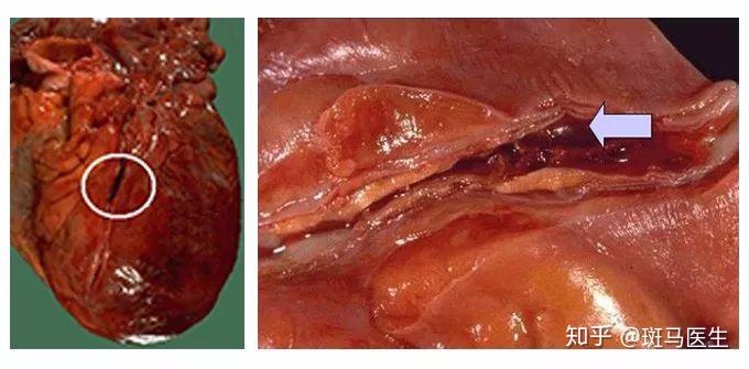 1768年,英国的heberden首先使用心绞痛(angina)一词.