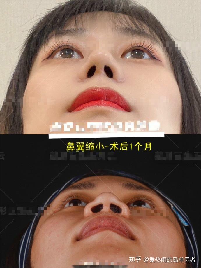 北京亲妈鼻自然直鼻测评