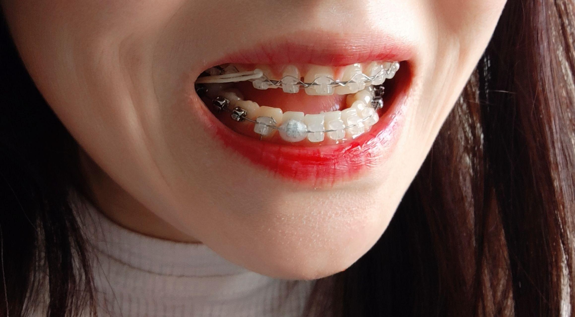 大龄正畸修复陶瓷自锁托槽牙缝和过小牙蜕变历程