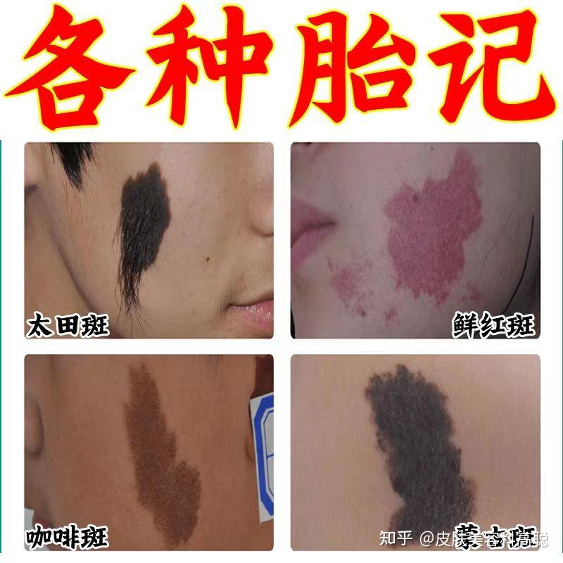 胎记都分为哪几种,怎么去除? - 知乎