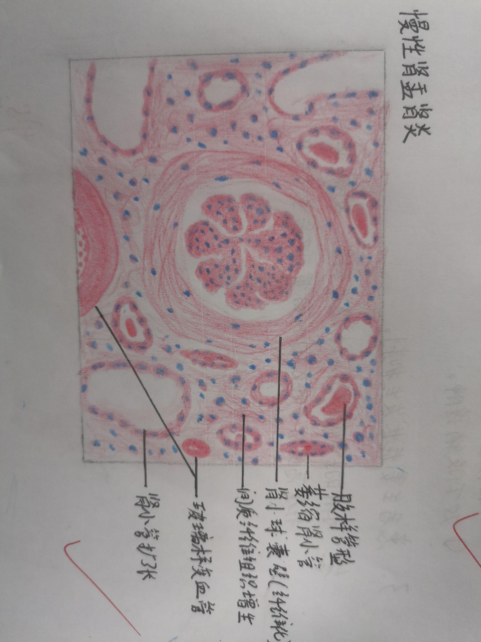 肾浊肿手绘实验报告图图片