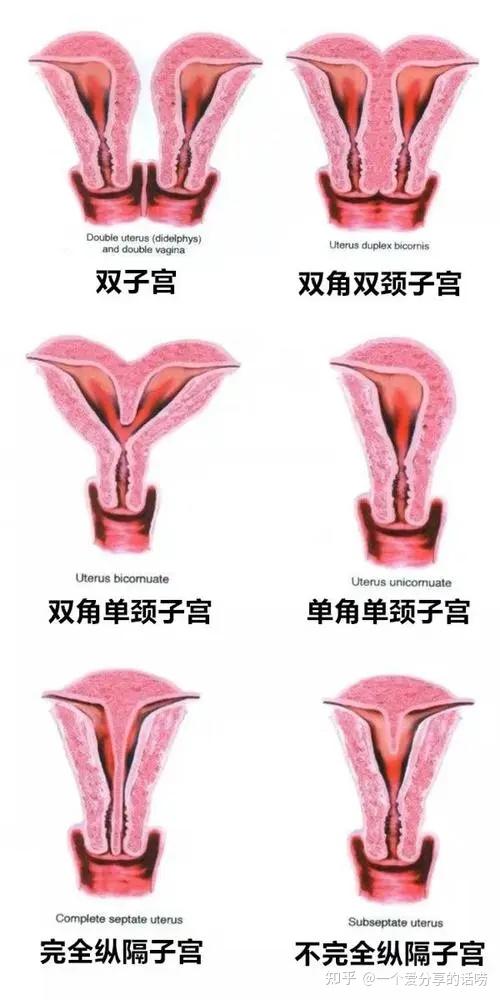 双子宫图片 结构图图片