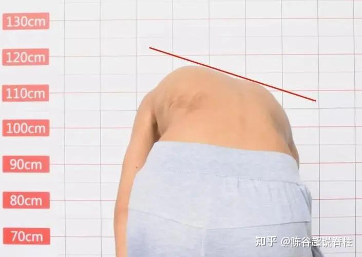 石家庄直乐大讲堂:是什么剃刀背一定是脊柱侧弯吗?关系分析来咯 - 知乎