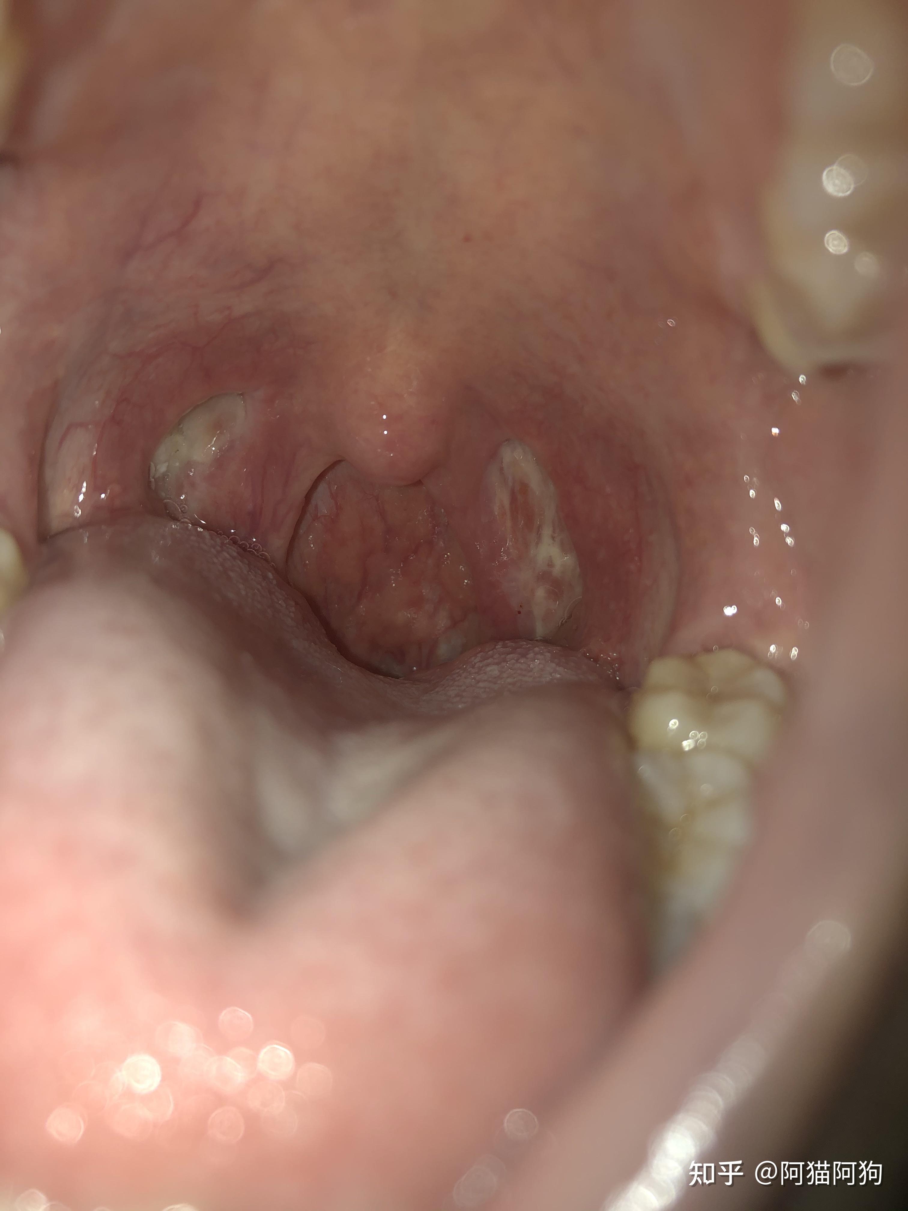 今天是扁桃体术后第20天,扁桃体术后的恫好像没那么深了,17号已经开始