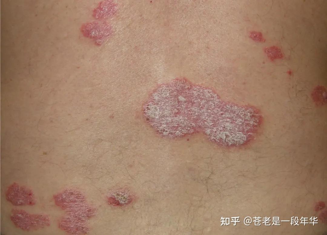 分享治疗牛皮癣的经历