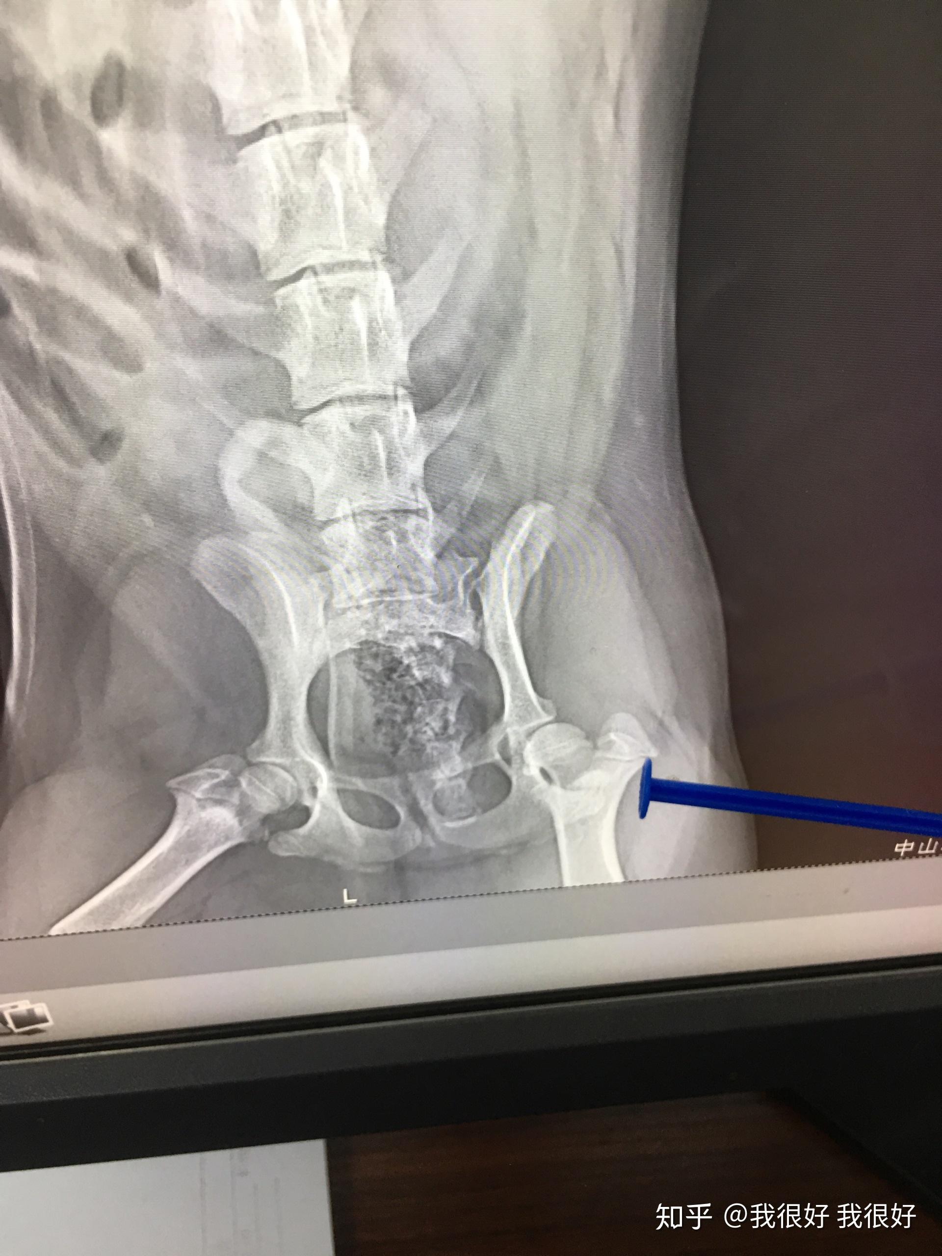 怎么治疗狗狗髋关节发育不良