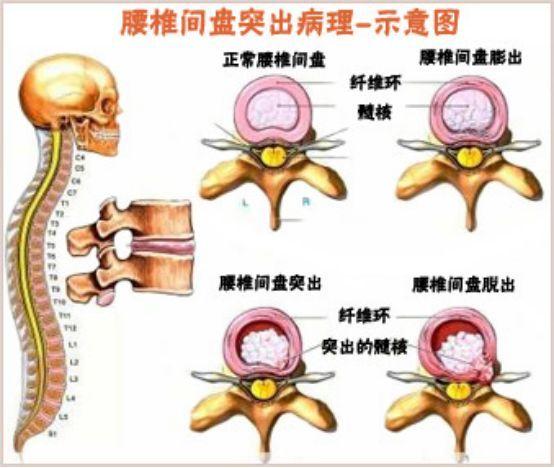 为什么年轻人会出现腰椎间盘突出症腰椎间盘突出自我复位腰椎间盘突出