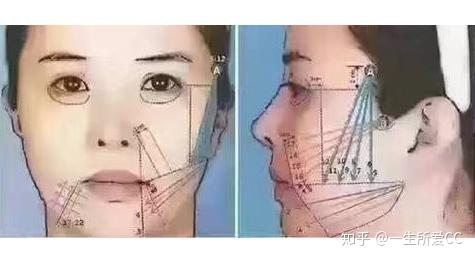 面雕是什么？面部线雕后的后遗症怎么避免？ - 知乎