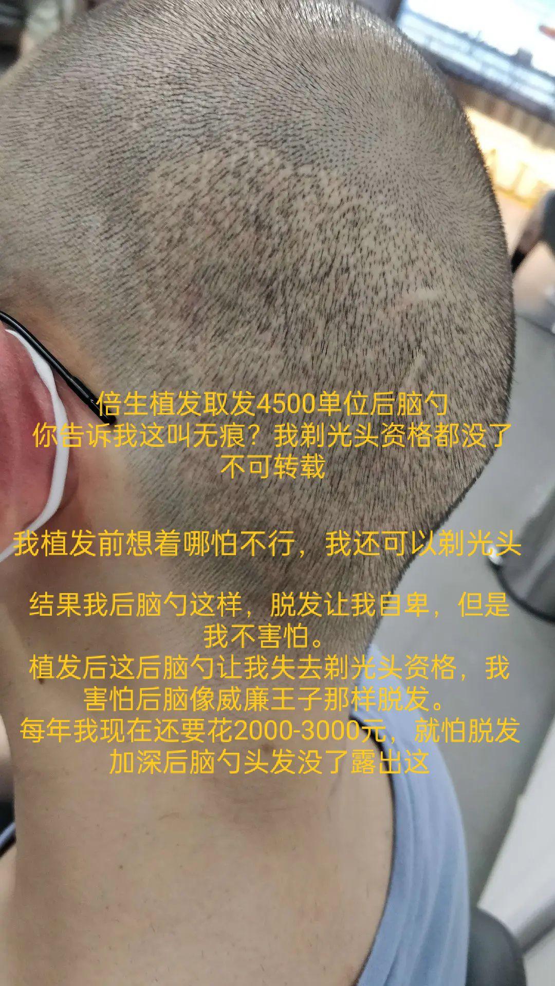 植发要挨多少针倍生植发亲身经历者