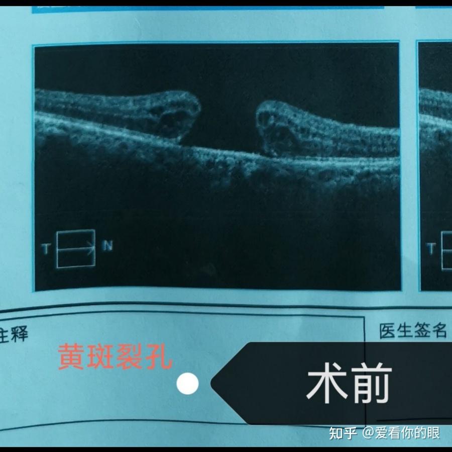 實例展示眼睛黃斑裂孔手術治療成功與未成功對比