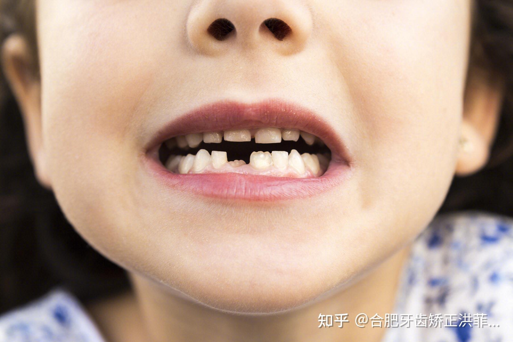 合肥儿童齿科哪家好—孩子在换牙期出现牙齿不齐需要矫正吗?