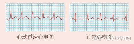 正常成人静息心率的预期值为每分钟60至100次