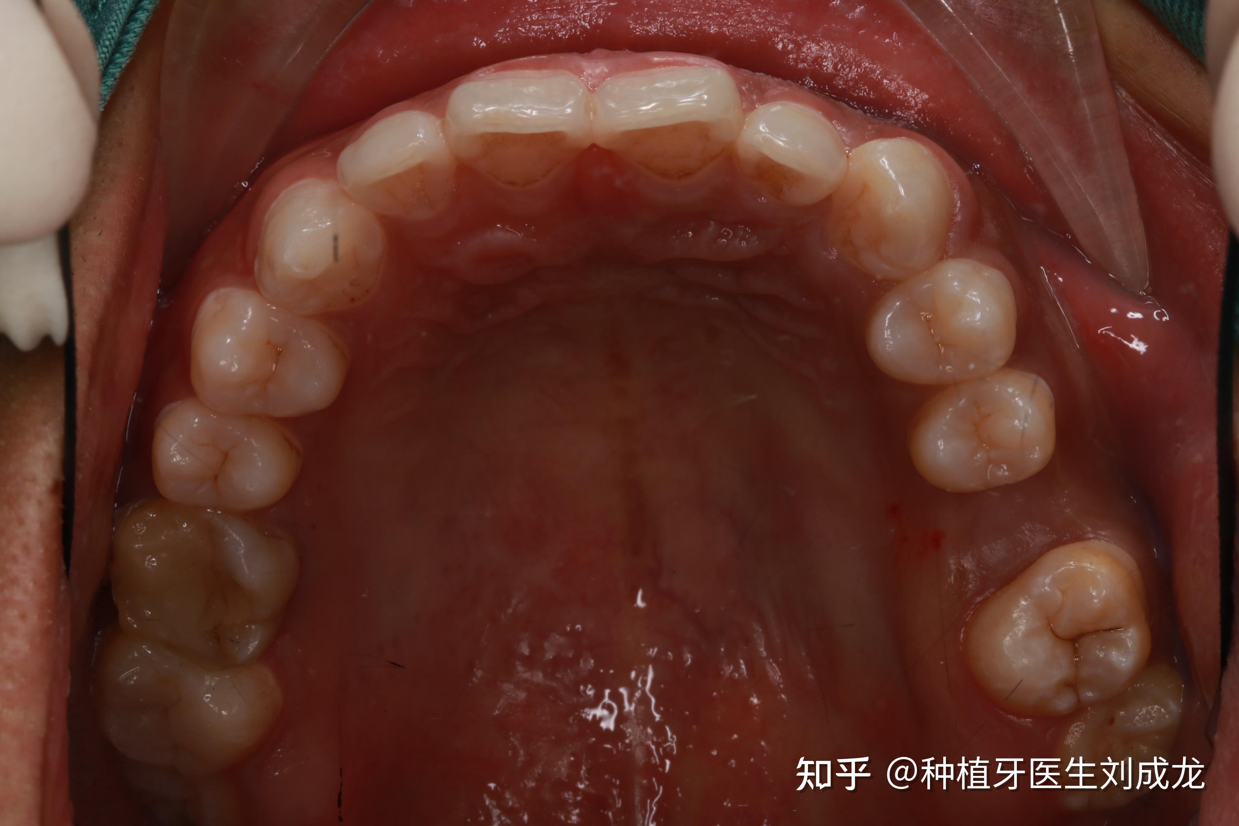 郑州瑞士iti种植牙医生刘成龙上颌磨牙区单颗种植案例