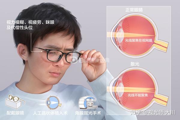 散光是什么 - 知乎