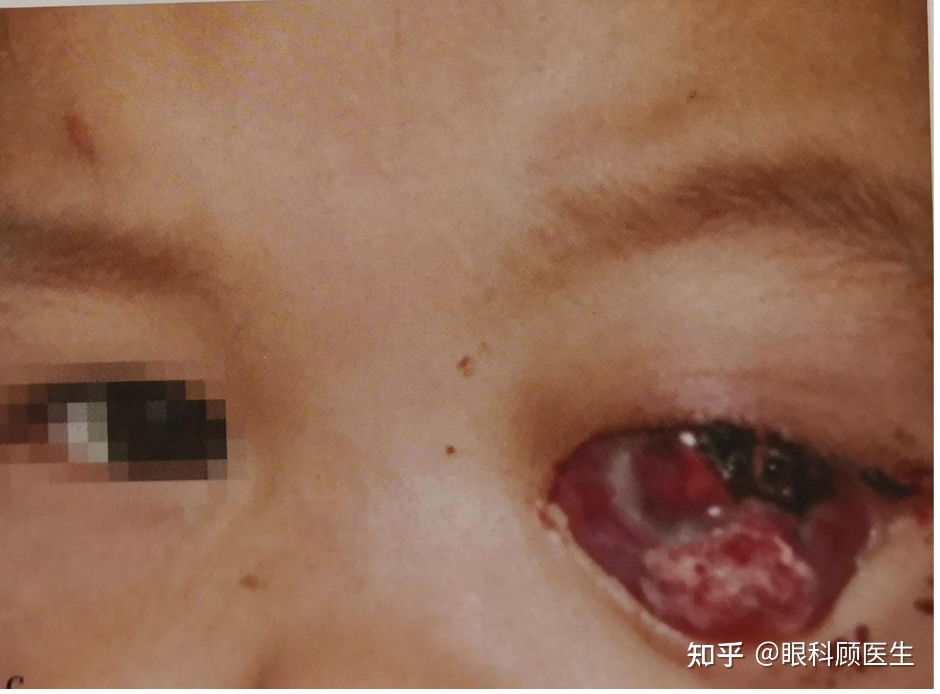 小孩眼睛视网膜瘤图片图片