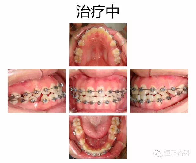 反合、开合、偏合的矫正 - 知乎