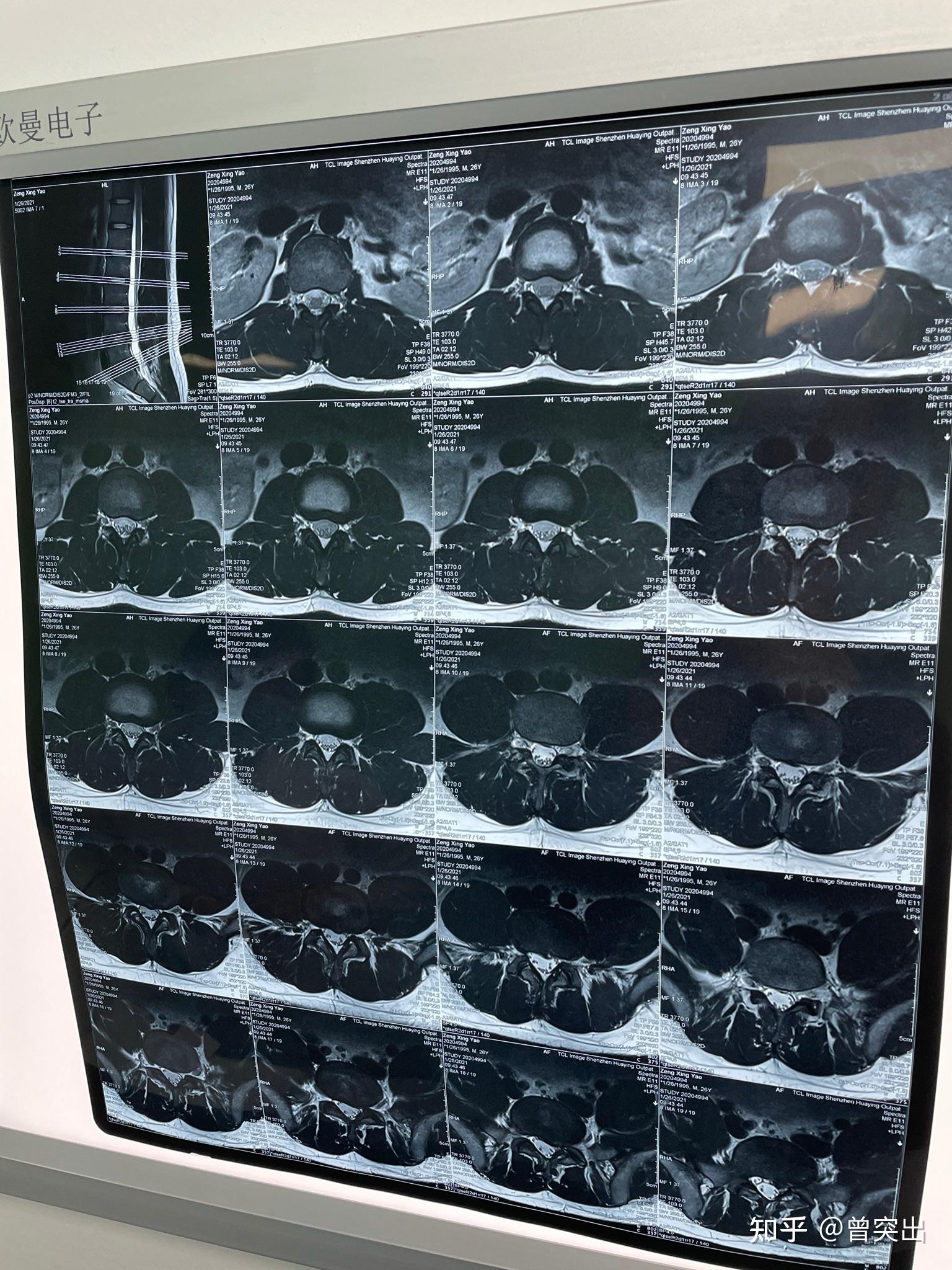 椎间盘核磁图片