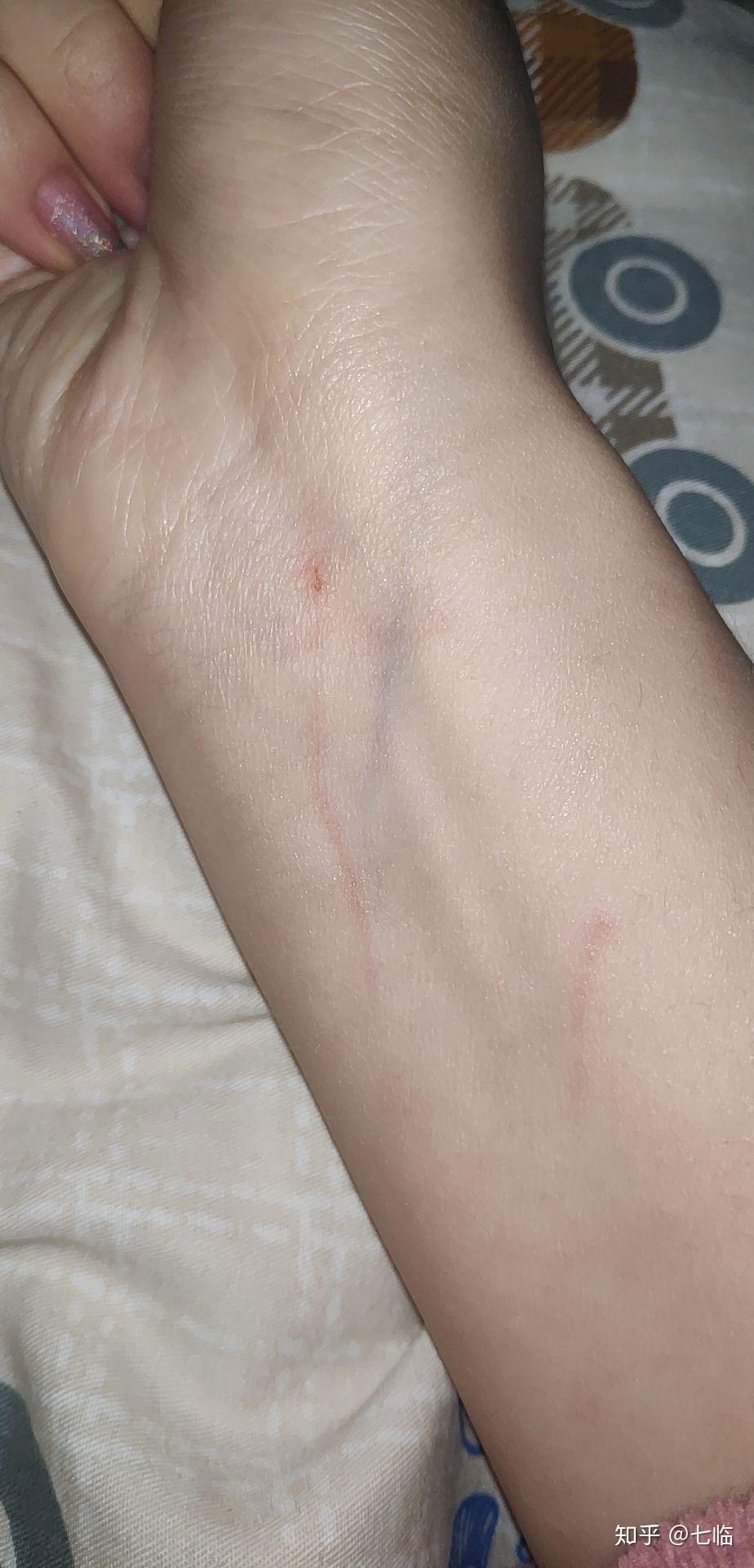 刚刚被猫抓伤了出了一点血大概是表皮的我刚刚舔了一下伤口用不用打