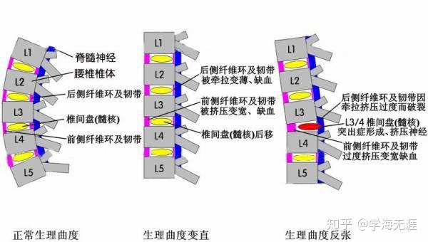 退化和腰椎病的产生,本质是从腰背的肌肉劳损开始,以椎间盘受力不平衡