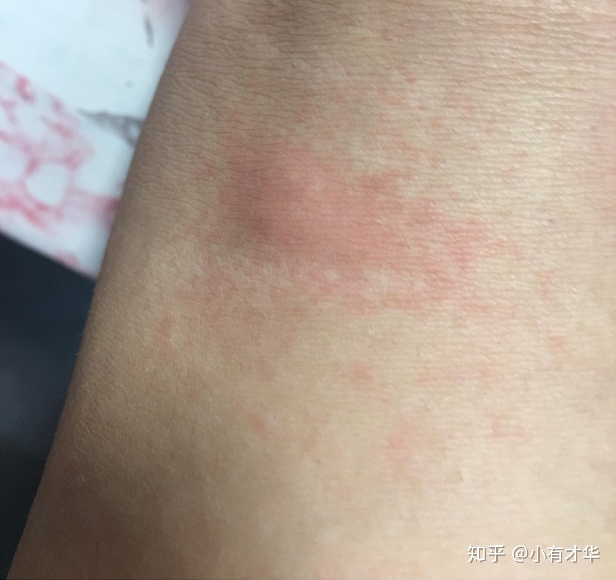 一开始是比较刺痛的,就不只感觉到被蛰的那个地方痛,有时大腿里面局部