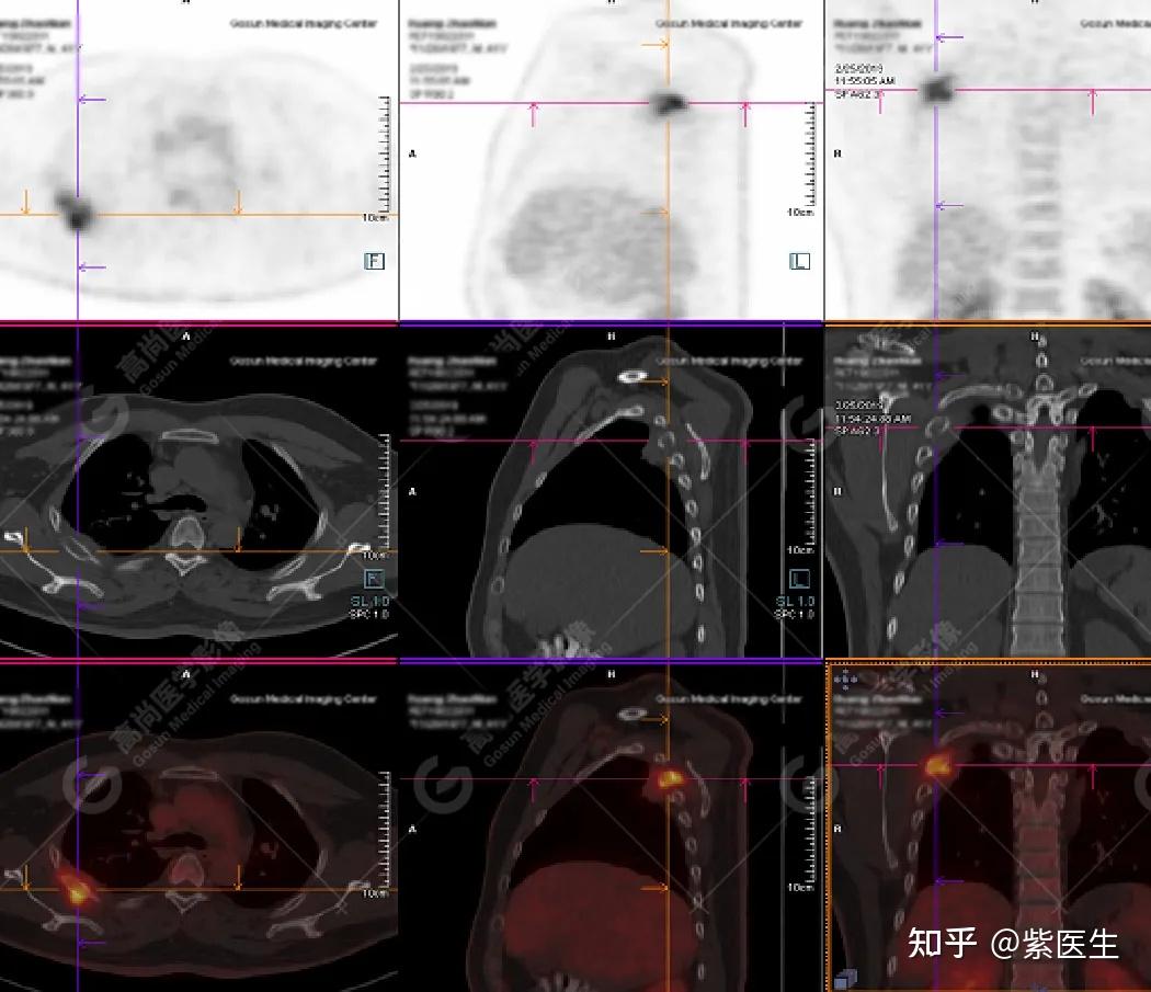 高尚醫學影像病例異病同影petct病例單發肋骨破壞