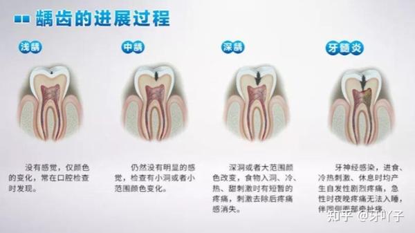 得了龋齿，如何自我判断严重程度？ 知乎