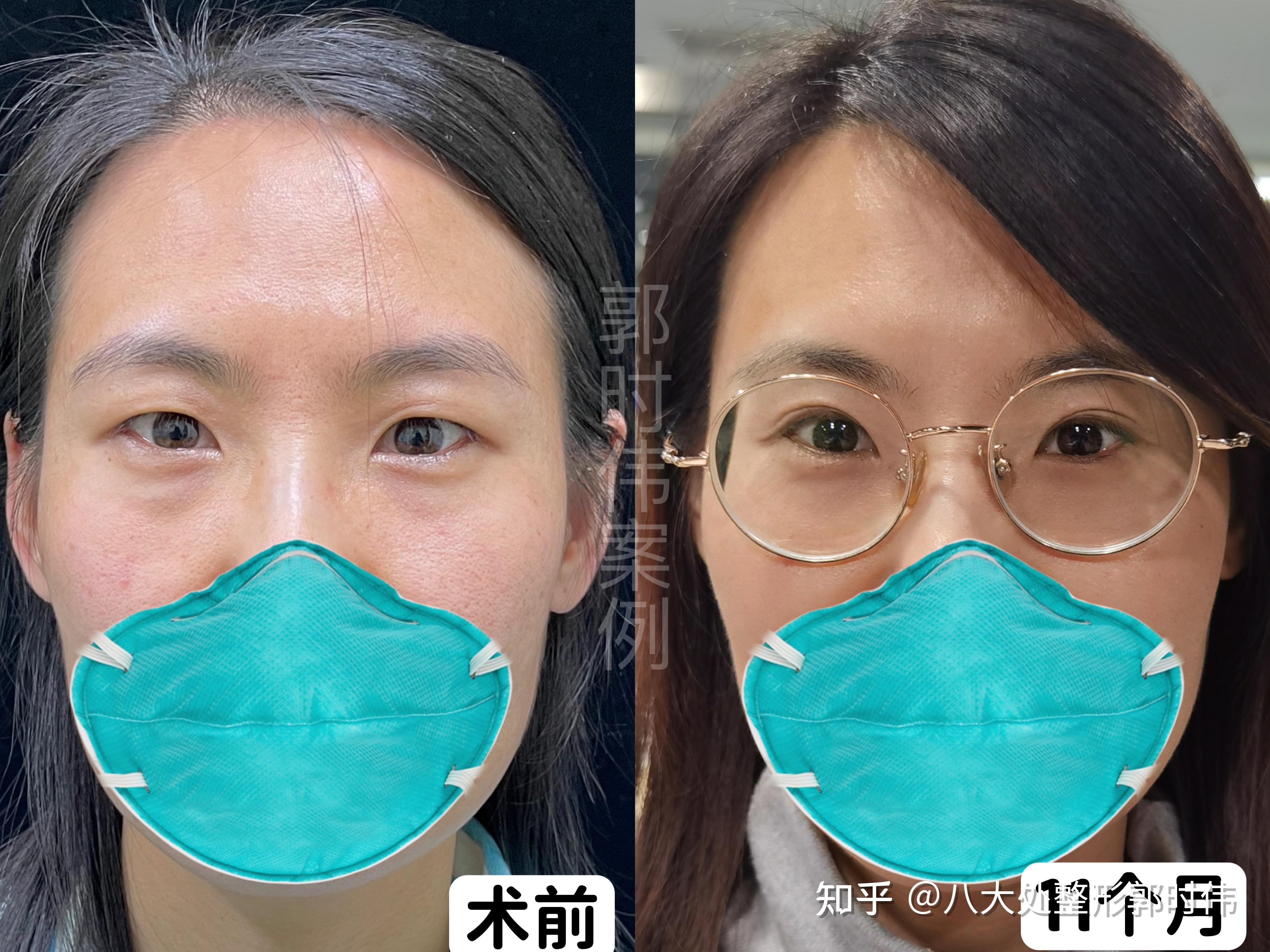 北京医院双眼皮案例分享（丁金萍）全切双眼皮+眶隔释放 - 知乎