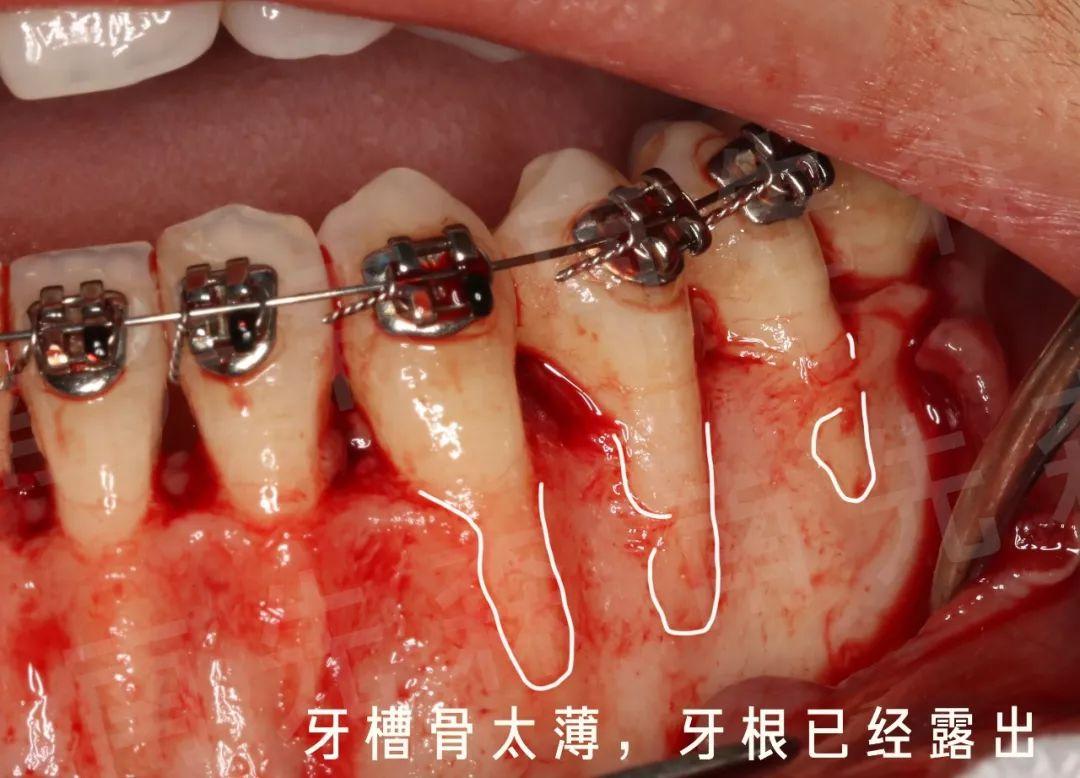 唇侧骨非常薄的牙齿进行矫正时,需要用骨填补材料进行骨移植↓牙槽骨
