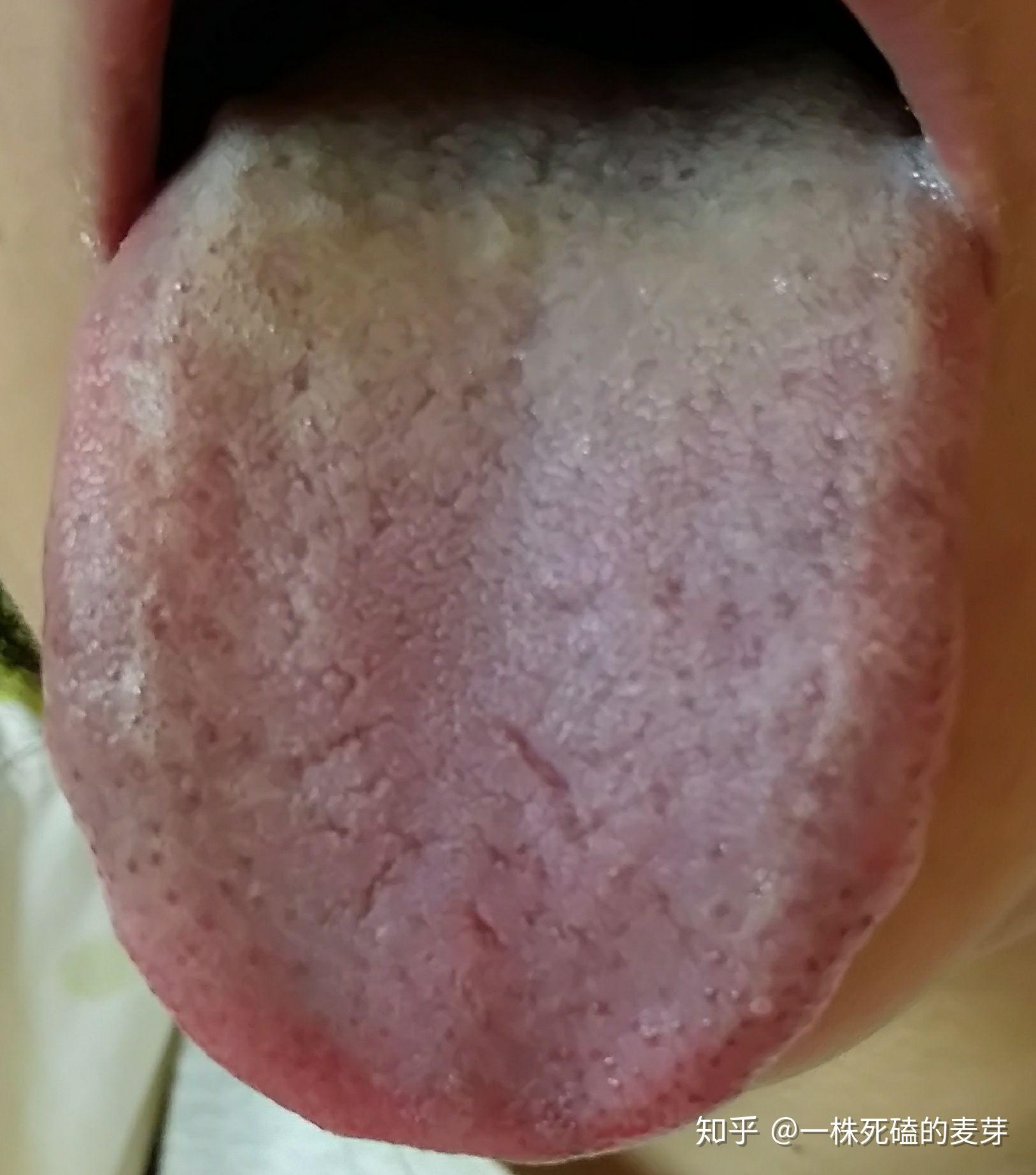 舌苔到底是什么？为什么舌苔厚就是积食了？