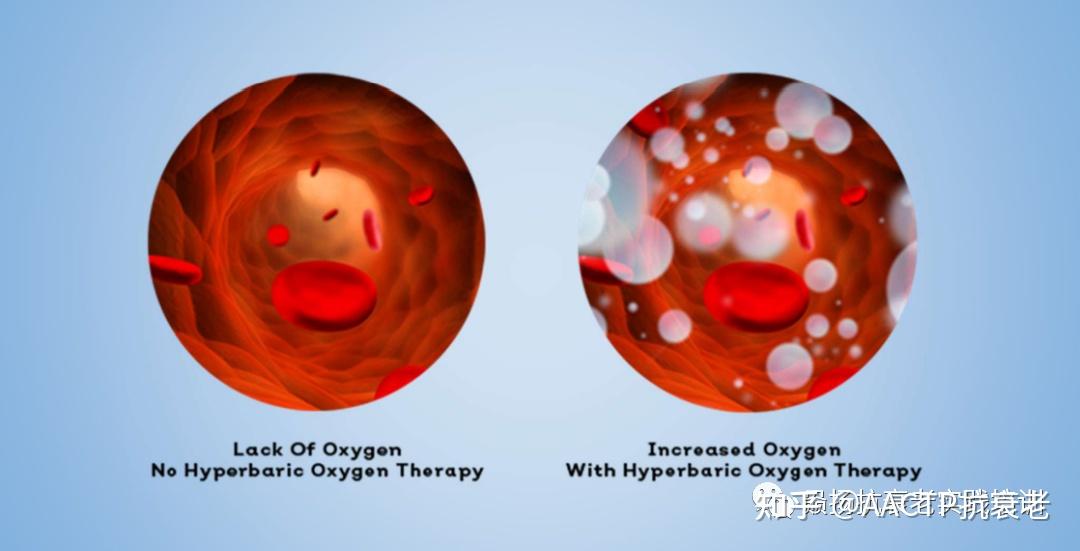 HBOT高压氧治疗为你的细胞再生和健康“打气” - 知乎
