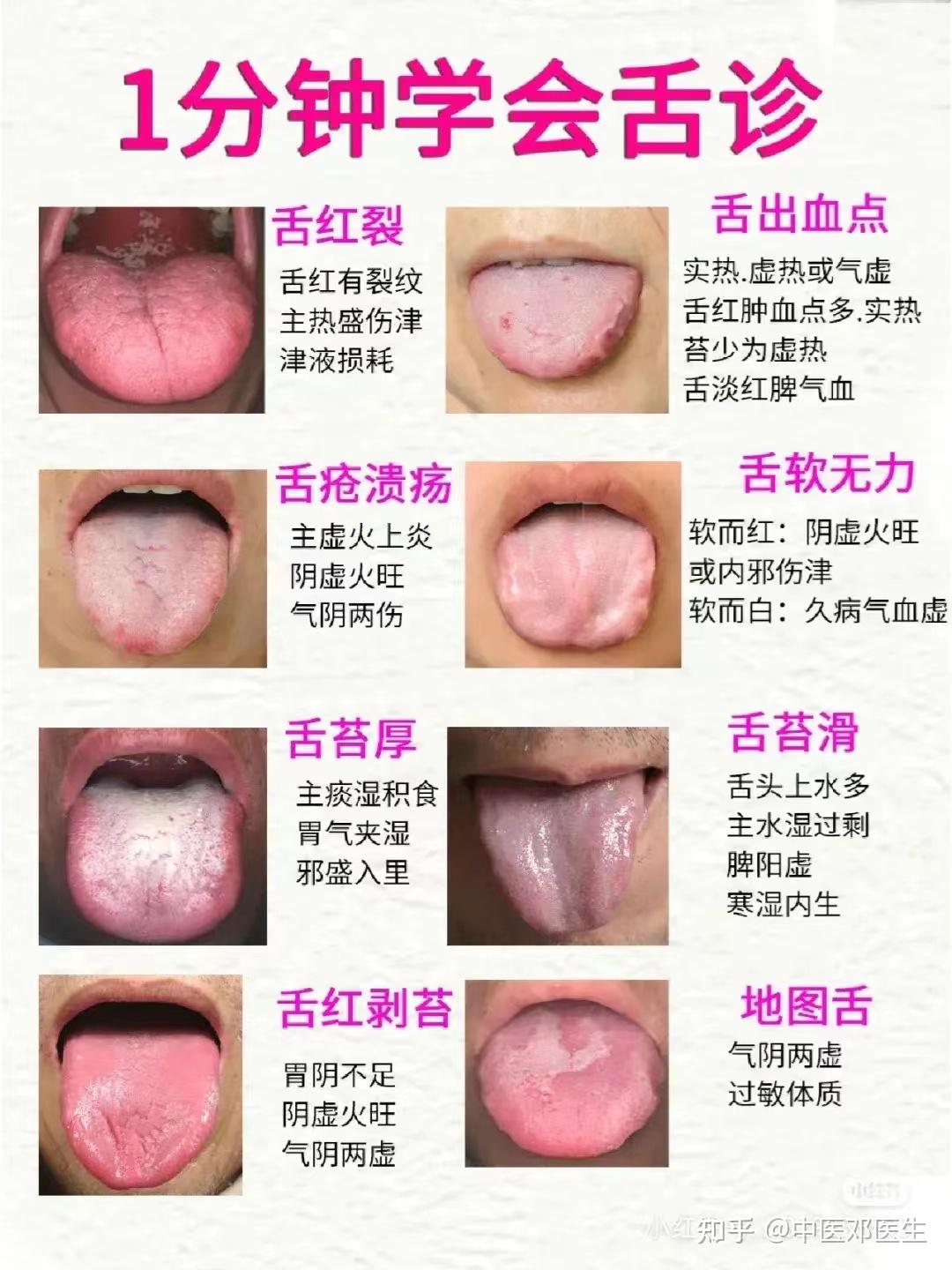 整理了一些常见的舌象，大家可以对照一下 - 知乎