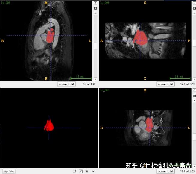 基于UNet的医学心脏图像语义分割 UNet的医学心脏图像语义分割项目 MSD心脏分割数据集 - 知乎