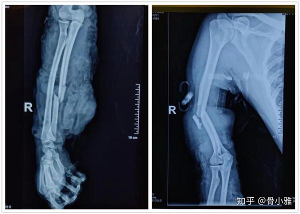 湘雅骨科唐举玉教授团队采用最新骨整形技术成功救治中年男子右上肢毁