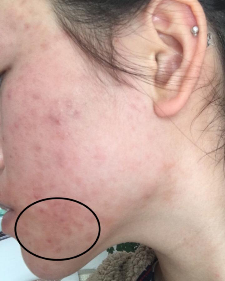 阿达帕林擦鸡皮肤(鸡皮肤涂阿达帕林多长时间才能消除) 阿达帕林擦鸡皮肤(鸡皮肤涂阿达帕林多长时间才能消除)