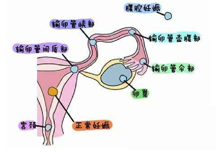 造成间质部妊娠的原因原来是这些