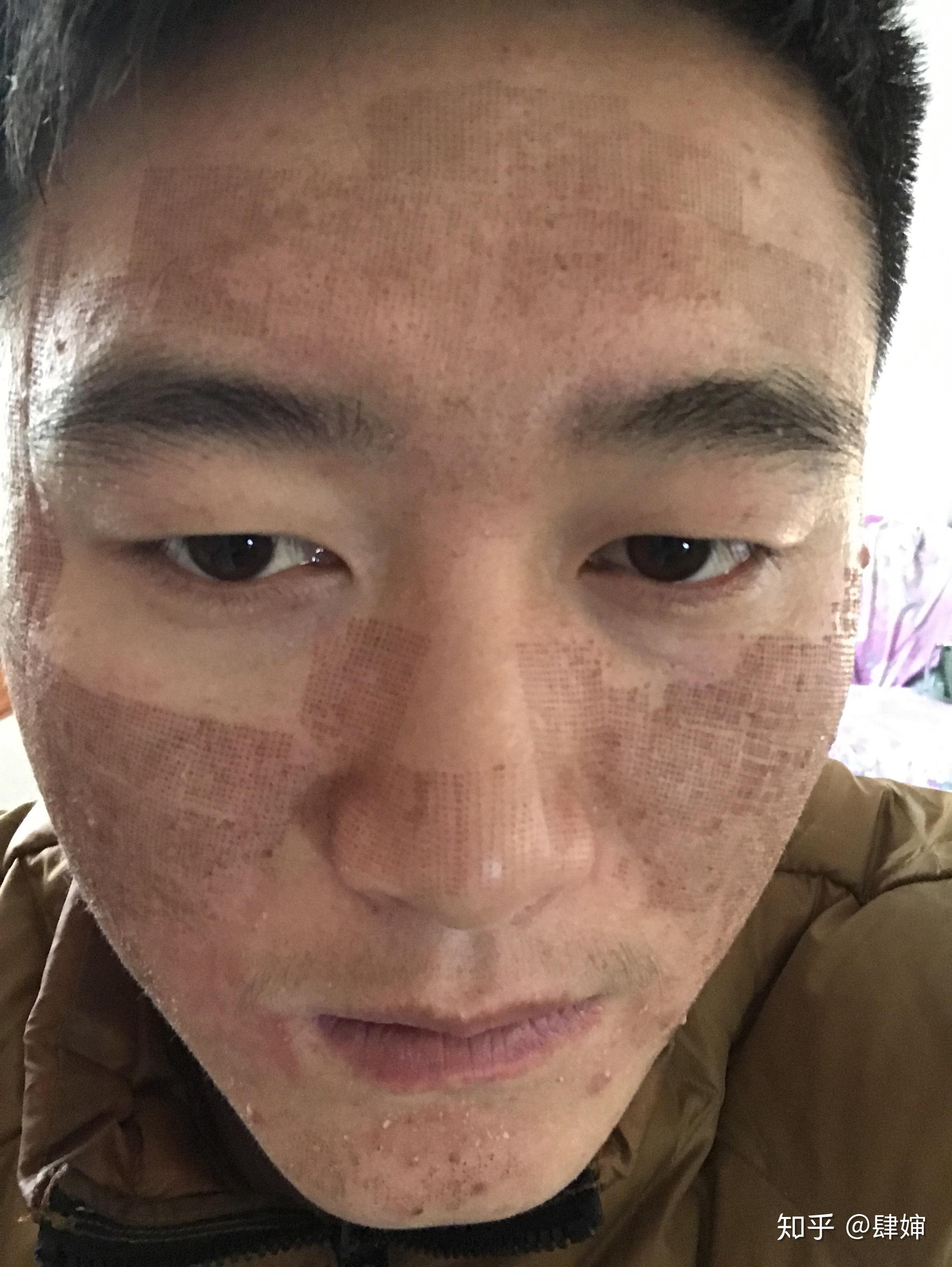 记录下点阵激光治痘坑