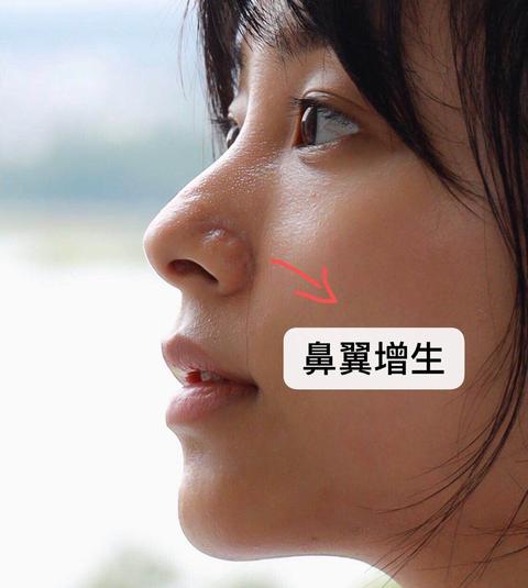 因为小时候鼻翼两侧经常性长痘,导致鼻翼两侧有痘坑和增生,且鼻子上