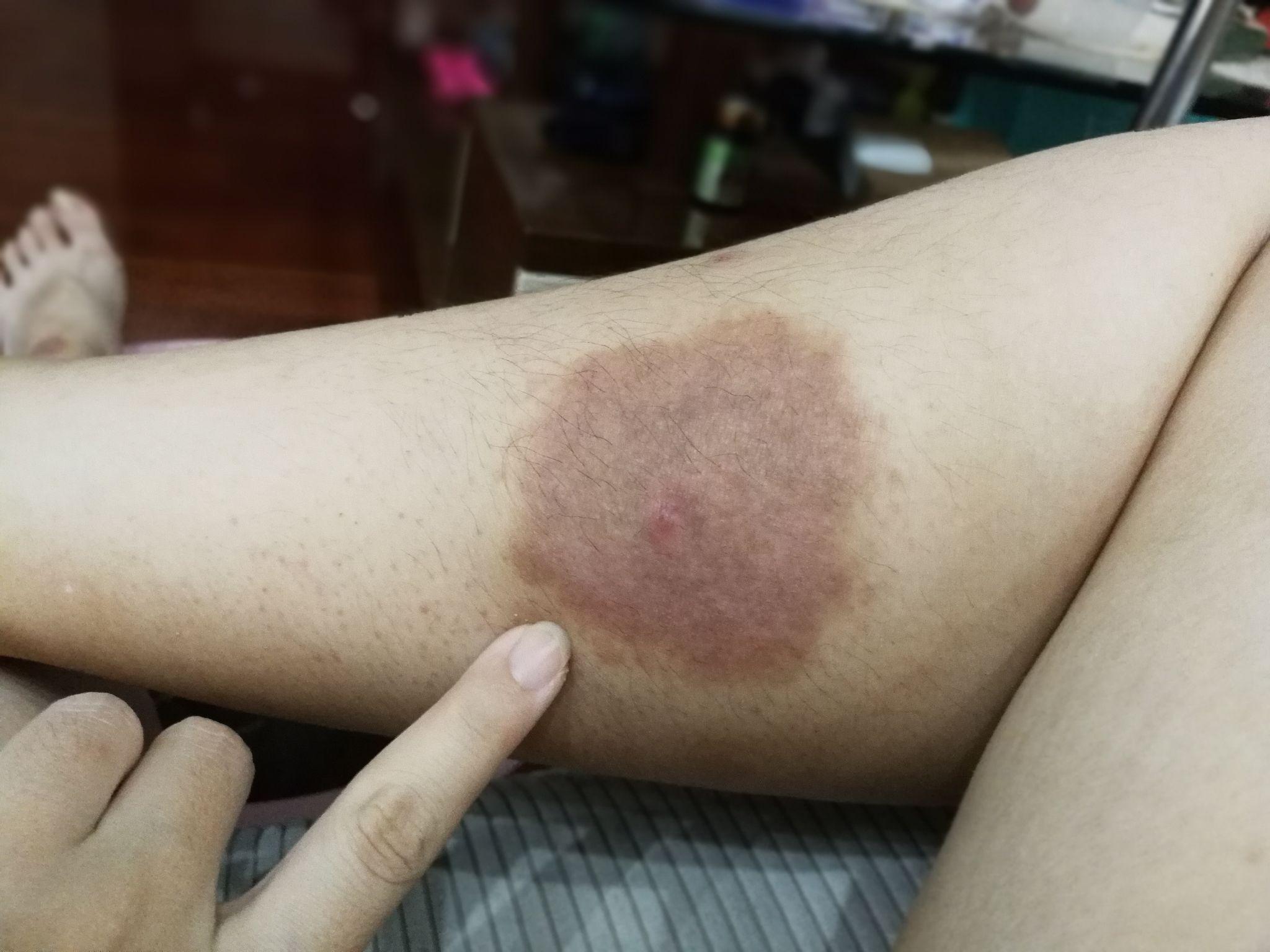 我是一名慢性湿疹患者此文章创建的意义在于鼓励其他身患湿疹的人一起