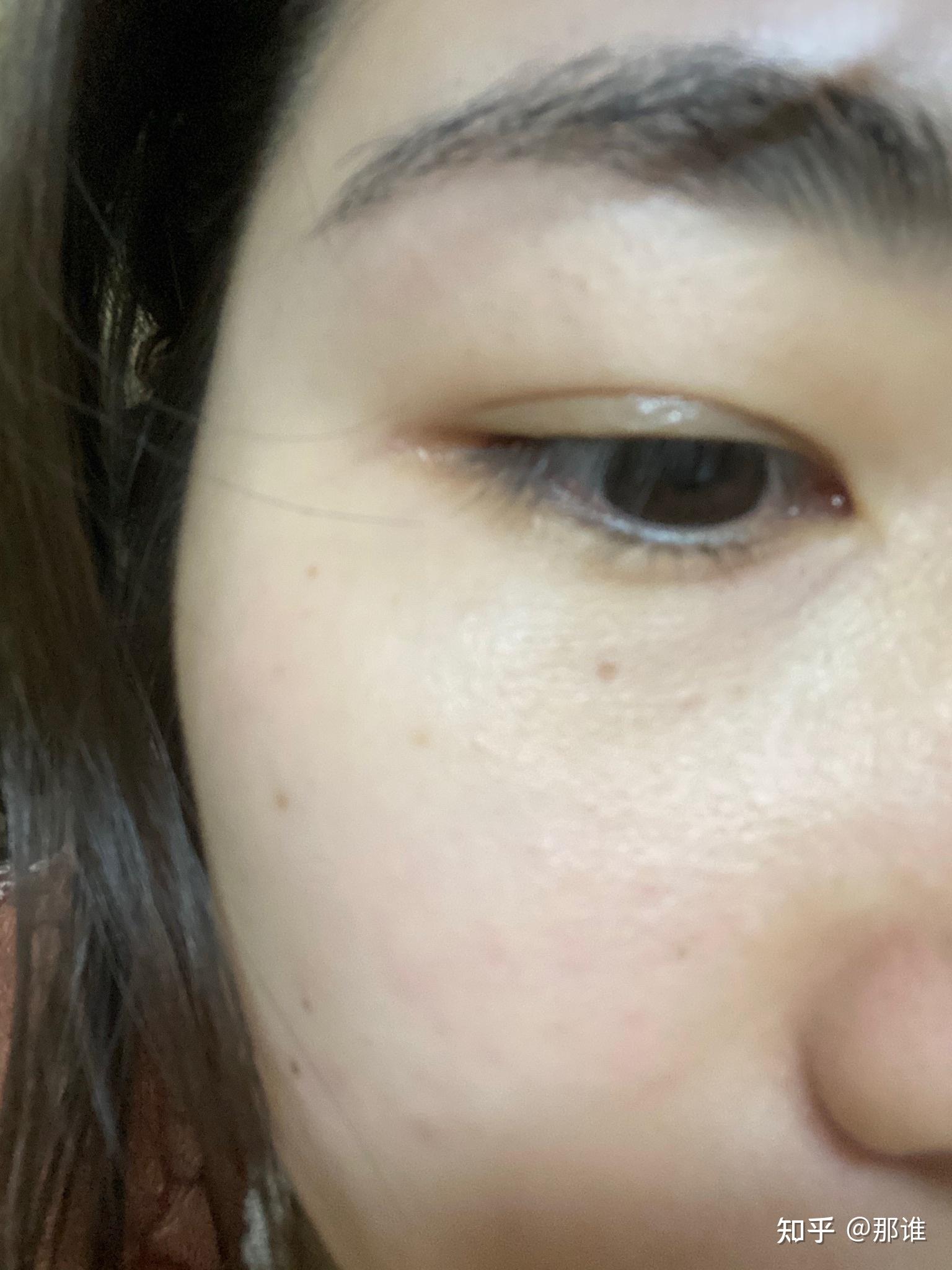 记录一下眼周细纹变化 - 知乎