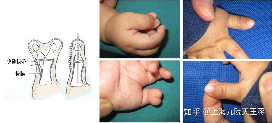 多指畸形—家长们看这一篇就够了 - 知乎